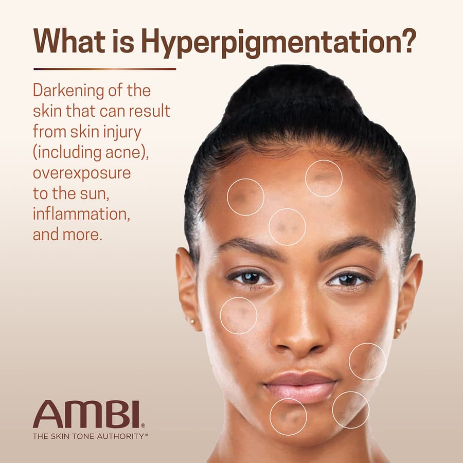 Ambi Even Clear Advanced Fade Cream Hydroquinone Free Hyperpigmentation