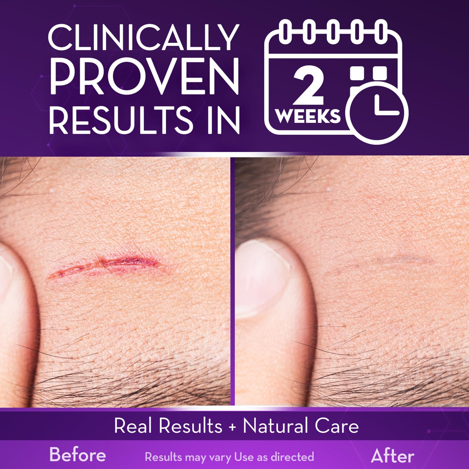 Cicatricure Advanced Scar Gel for Face Body Proven Results In 2 Weeks Scar - Thumbnail 3